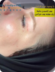 بلفاروپلاستی