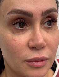 لیفت صورت و شقیقه