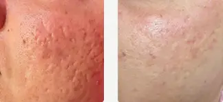 تیجه 4 جلسه درمان با دستگاه frax pro