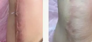 ليزر خط بخيه با دستگاه فركس پرو از كمپاني كندلا