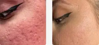 نتیجه ۴ جلسه استفاده از دستگاه frax pro برای از بین بردن آکنه اسکار صورت و جوانسازی پوست