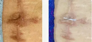 لیزر خط بخیه بعد از ۱ جلسه با دستگاه فرکس پرو از کمپانی کندلا،