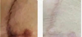 لیزر خط بخیه بعد از ۱ جلسه با دستگاه فرکس پرو از کمپانی کندلا